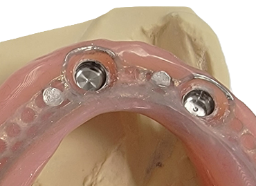 Prothèse sur 2 implants